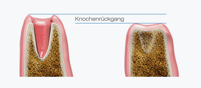 Bild zeigt schematisch den Rückgang des Zahnknochens