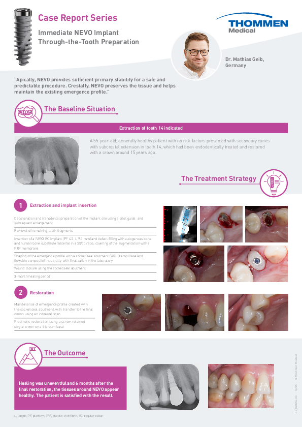 Fo_02d356_Clinical_Case_Geib_Immed._NEVO_after_Decoronation_00.pdf