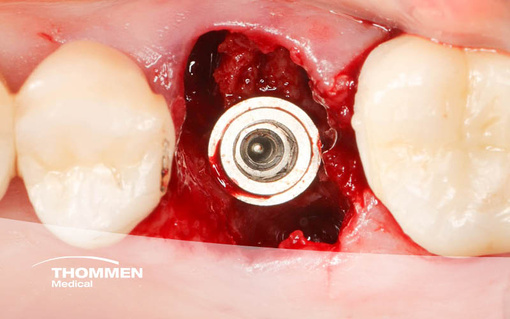 <p>Single Molar Tooth Rehabilitation With Immediate Implant Placement</p>