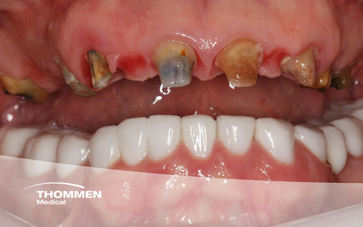 <p>A Staged Full Arch Approach Without Bone Removal</p>
