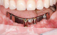 CONTACT Implants in an Extremely Atrophic Mandible