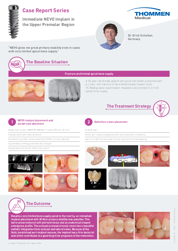 Fo_02d357_Clinical_Case_Schelker_Immediate_NEVO_Upper_Premolar_00.pdf