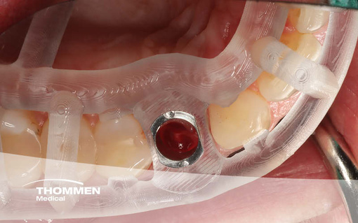 <p>Immediate Flapless Guided Placement of a NEVO Implant</p>