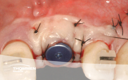 Clinical Cases: Explore the Versatility of the Thommen Medical Implant ...