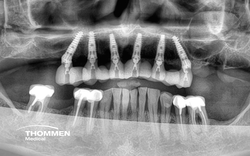 <p>Immediate NEVO Implant Placement for Full Maxillary Rehabilitation in Type 3 Bone</p>
