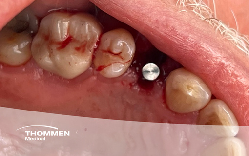 <p>Immediate Placement of NEVO in Premolar Extraction Socket&nbsp;</p>
