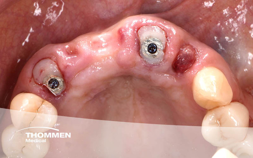 <p>Flapless Immediate Implantation of NEVO in the Anterior Maxilla&nbsp;</p>