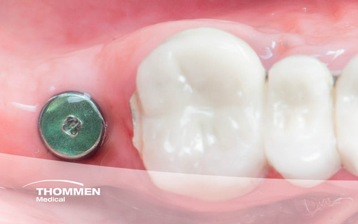 <p>Successful Rehabilitation of a Fractured Molar Tooth with NEVO</p>