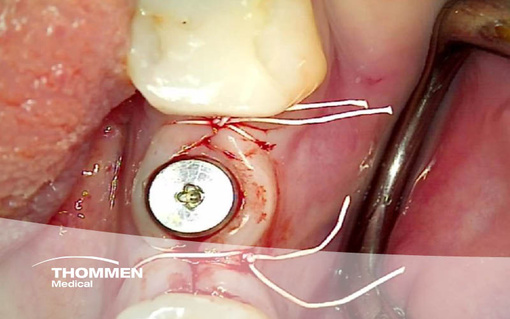 <p>Rehabilitation of a Lower Molar Tooth With NEVO in a Healed Site</p>