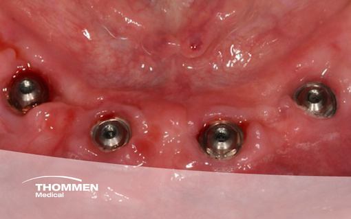 <p>Fully Digital Mandibular Rehabilitation with NEVO in Type 1 Bone</p>