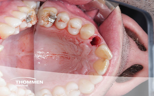 <p>Extraction, Immediate Implantation, and Provisional Restoration With the Socket-Shield Technique</p>
