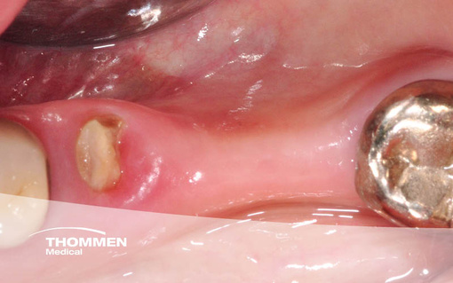 <p>Rehabilitation of Large Tissue&nbsp;Deficits, Immediate NEVO&nbsp;Placement and Simultaneous GBR</p>