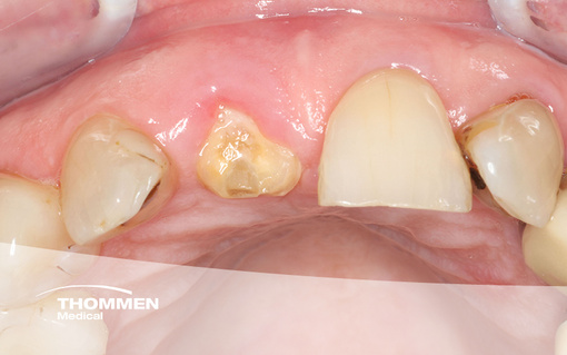 <p>Immediate Fully Guided Implantation of NEVO in the Esthetic Zone</p>