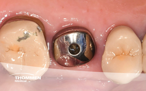 <p>Immediate NEVO Implant Placement for a Single Tooth in the Molar Area</p>