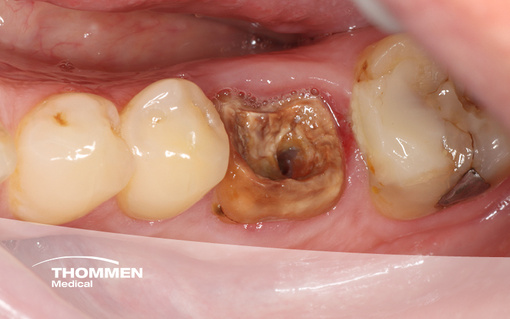 <p>Immediate Implantation with NEVO on Tooth 36</p>
