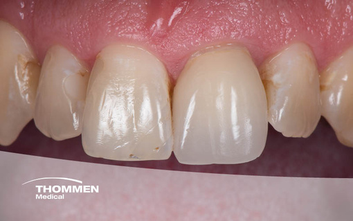 <p>Placement of an ELEMENT Implant with&nbsp;the Socket Shield Technique</p>