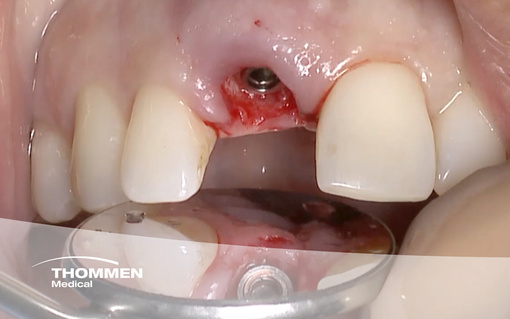 <p>Immediate Implant Placement and GBR in the Esthetic Area</p>